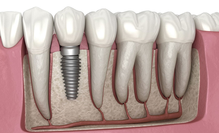 Dental-implant-illustration